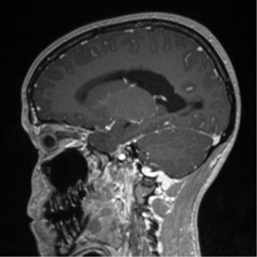 Central neurocytoma (Radiopaedia 37664-39557 Sagittal T1 C+ 62).png