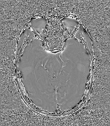 File:Central neurocytoma (Radiopaedia 84497-99872 Axial 26).jpg