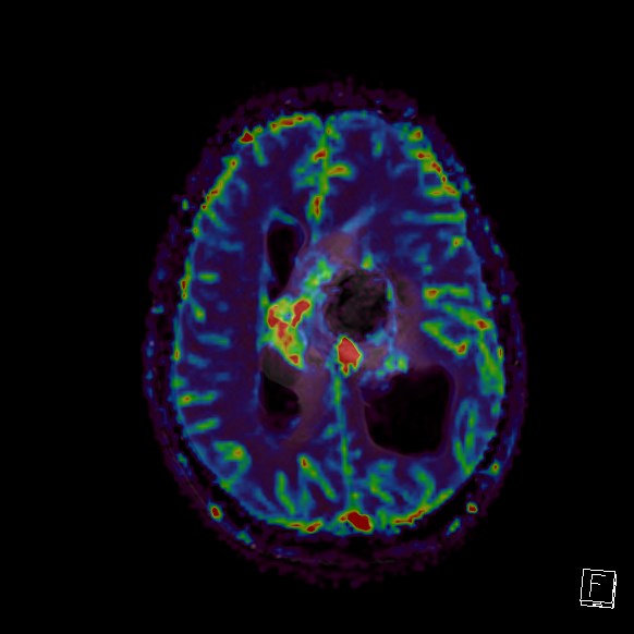Central neurocytoma (Radiopaedia 84497-99872 Axial Perfusion 117).jpg