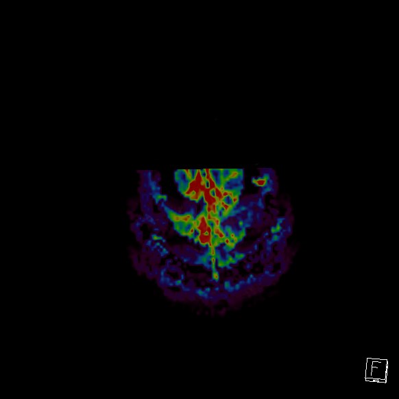 Central neurocytoma (Radiopaedia 84497-99872 Axial Perfusion 9).jpg