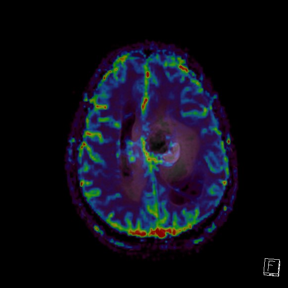 Central neurocytoma (Radiopaedia 84497-99872 Axial Perfusion 98).jpg