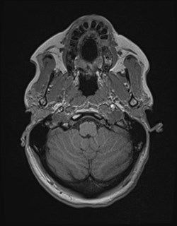 Central neurocytoma (Radiopaedia 84497-99872 Axial T1 39).jpg