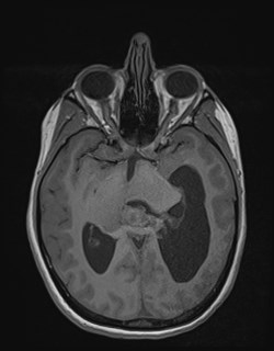 Central neurocytoma (Radiopaedia 84497-99872 Axial T1 90).jpg