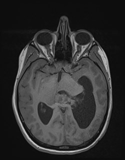 Central neurocytoma (Radiopaedia 84497-99872 Axial T1 91).jpg