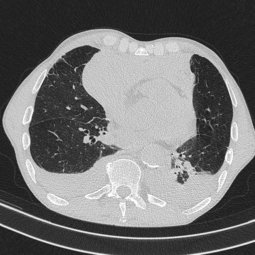 Central venous catheter tip extravasation (Radiopaedia 82828-97113 Axial lung window 55).jpg