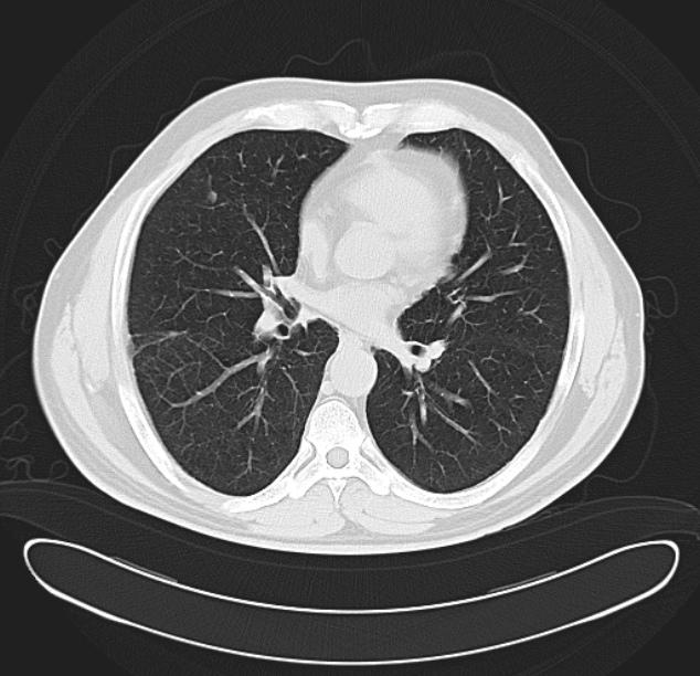 Centrilobular pulmonary emphysema (Radiopaedia 26808-26971 C 25).jpg