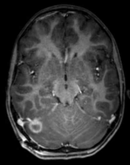 Cerebellar abscess (Radiopaedia 73727-84563 Axial T1 C+ fat sat 56).jpg