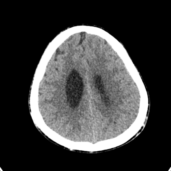 Cerebellar abscess secondary to mastoiditis (Radiopaedia 26284-26412 Axial non-contrast 120).jpg