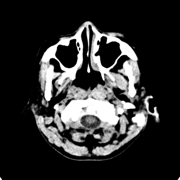File:Cerebellar abscess secondary to mastoiditis (Radiopaedia 26284-26412 Axial non-contrast 7).jpg