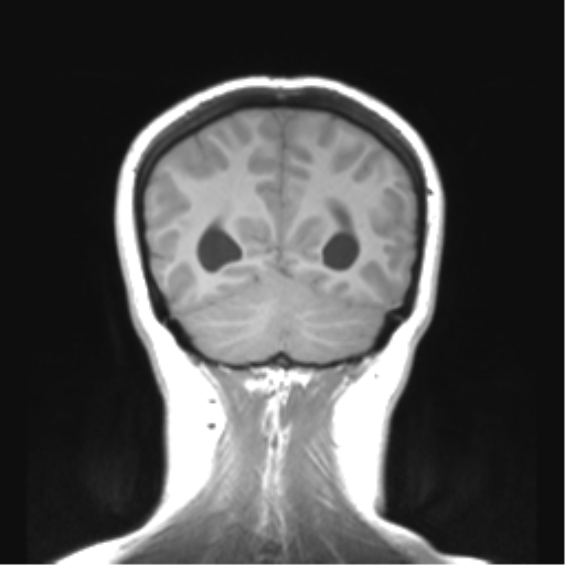 Cerebellar ependymoma complicated by post-operative subdural hematoma (Radiopaedia 83322-97736 Coronal T1 46).png