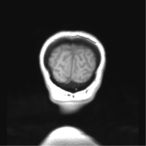 Cerebellar ependymoma complicated by post-operative subdural hematoma (Radiopaedia 83322-97736 Coronal T1 55).png