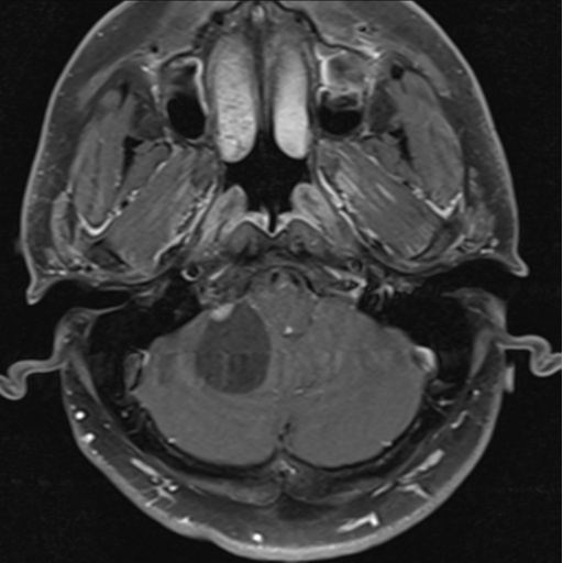 File:Cerebellar hemangioblastomas and pituitary adenoma (Radiopaedia 85490-101176 Axial T1 C+ fat sat 7).png