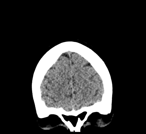 Cerebellar metastases - colorectal adenocarcinoma (Radiopaedia 40947-43652 Coronal non-contrast 17).png