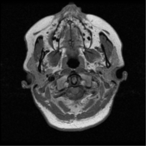File:Cerebellar metastases - colorectal adenocarcinoma (Radiopaedia 40947-43655 Axial T1 1).png