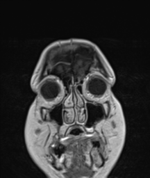 File:Cerebellar metastasis (Radiopaedia 54578-60810 Coronal T1 C+ 2).png