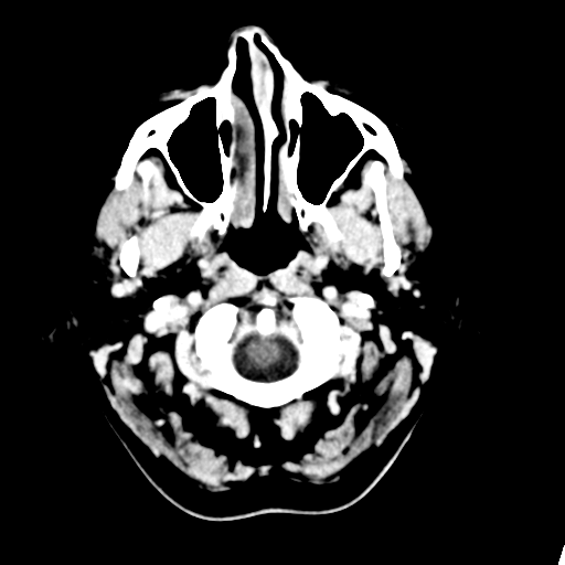 Cerebellar metastasis (Radiopaedia 54578-60812 Axial C+ 2).png