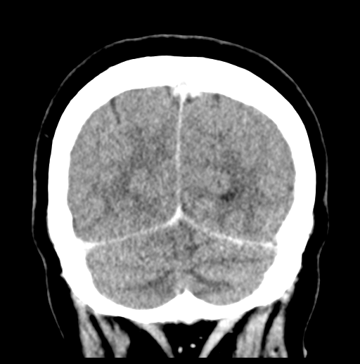 Cerebellar metastasis (Radiopaedia 54578-60812 Coronal C+ 51).png