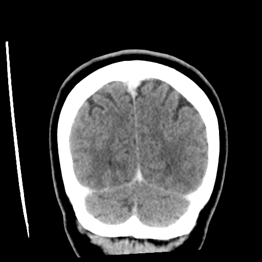 Cerebellar metastasis (cystic appearance) (Radiopaedia 41395-44258 D 51).png