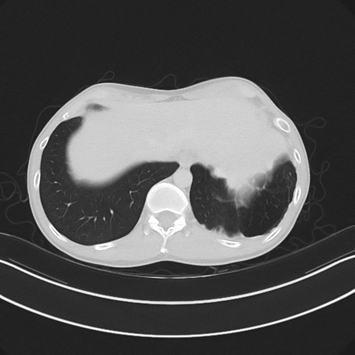 Cerebellar metastasis - adenocarcinoma lung (Radiopaedia 63184-71717 Axial lung window 59).png