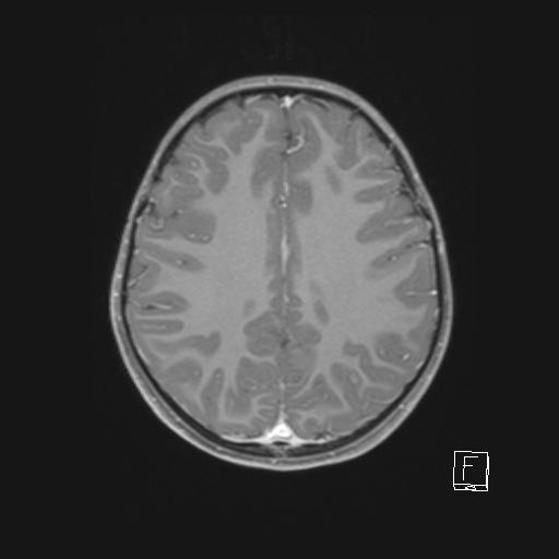 Cerebellar stroke (Radiopaedia 32202-33150 Axial T1 C+ 49).png