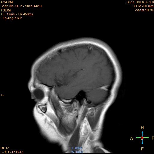 File:Cerebellopontine angle meningioma (Radiopaedia 22488-22525 Sagittal T1 C+ 14).jpg