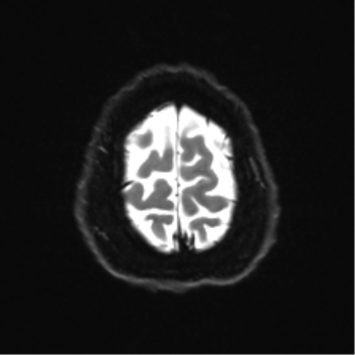Cerebellopontine angle meningioma (Radiopaedia 48434-53348 Axial DWI 36).png