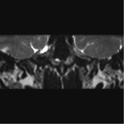Cerebellopontine angle meningioma (Radiopaedia 48434-53348 Coronal T2 68).png