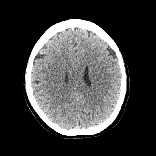 Cerebellopontine angle meningioma (Radiopaedia 53561-59592 Axial non-contrast 44).jpg