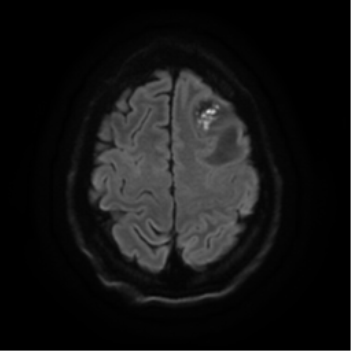 File:Cerebral abscess (Radiopaedia 57774-64740 Axial DWI 24).png