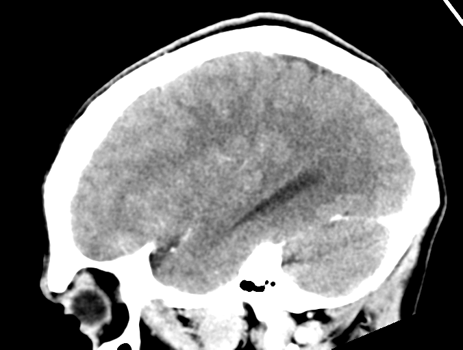 Cerebral abscess (Radiopaedia 60342-68008 Sagittal C+ delayed 14).png
