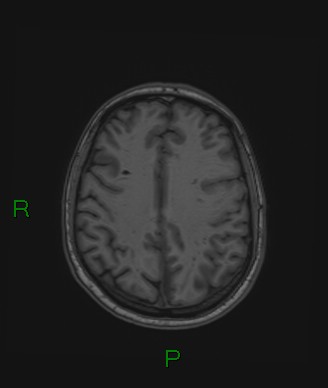 Cerebral abscess and subdural empyema (Radiopaedia 84436-99779 Axial T1 30).jpg