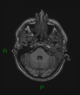 Cerebral abscess and subdural empyema (Radiopaedia 84436-99779 Axial T1 65).jpg