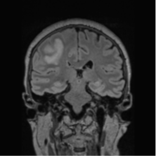 Cerebral abscess from pulmonary arteriovenous malformation (Radiopaedia 86275-102291 Coronal FLAIR 40).png