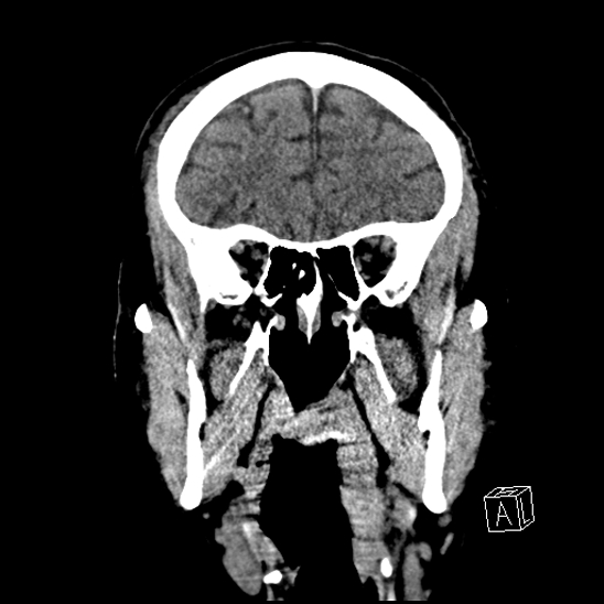 File:Cerebral abscess with ventriculitis (Radiopaedia 78965-91876 B 15).jpg
