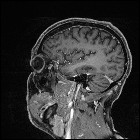 Cerebral abscess with ventriculitis (Radiopaedia 78965-91878 Sagittal T1 C+ 134).jpg