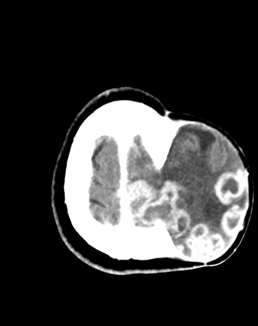 Cerebral abscesses (Radiopaedia 70458-80568 Axial Contrast 53).jpg