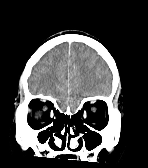 Cerebral abscesses (Radiopaedia 70458-80568 Coronal Contrast 16).jpg