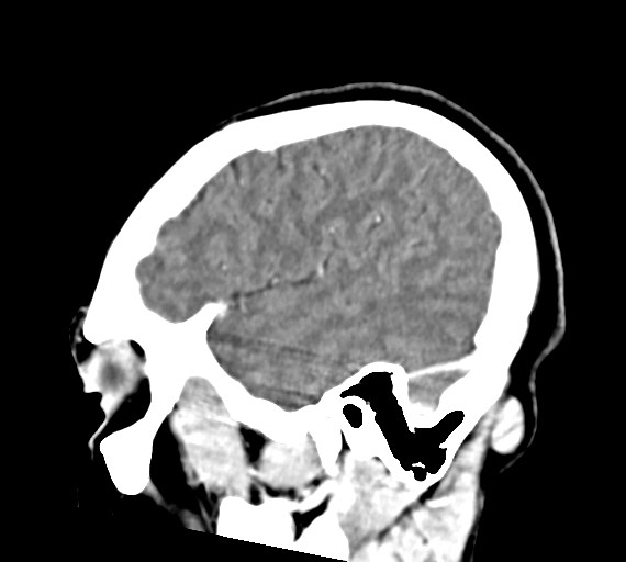 Cerebral abscesses (Radiopaedia 70458-80568 Sagittal Contrast 44).jpg