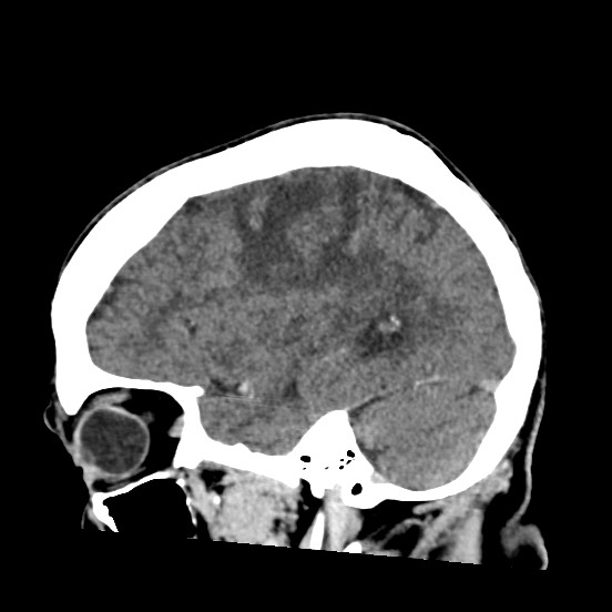 Cerebral amyloid angiopathy-related inflammation (Radiopaedia 74836-85848 C 18).jpg