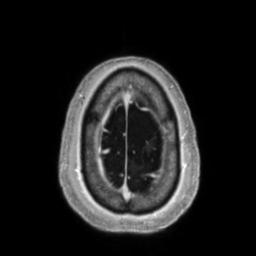 Cerebral amyloid angiopathy (Radiopaedia 29129-29518 Axial T1 C+ 138).jpg