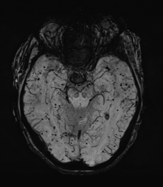 File:Cerebral amyloid angiopathy (Radiopaedia 46082-50433 Axial SWI MIP 28).png