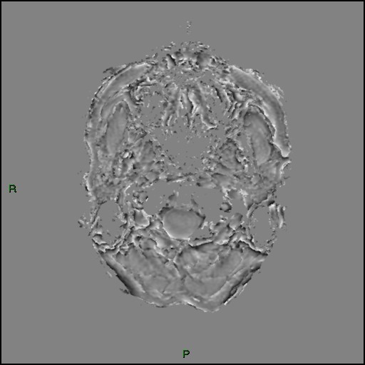 Cerebral amyloid angiopathy (Radiopaedia 77506-89664 H 5).jpg
