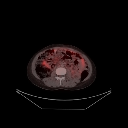 Cerebral and abdominal tuberculosis (Radiopaedia 90499-107853 C 178).jpg