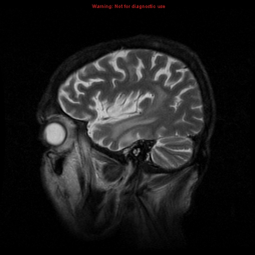 File:Cerebral and orbital tuberculomas (Radiopaedia 13308-13311 Sagittal T2 4).jpg