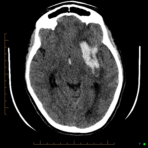 Cerebral arteriovenous malformation (AVM) (Radiopaedia 78162-90706 Axial non-contrast 29).jpg