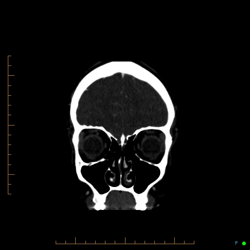 Cerebral arteriovenous malformation (AVM) (Radiopaedia 78162-90706 Coronal CTA 84).jpg