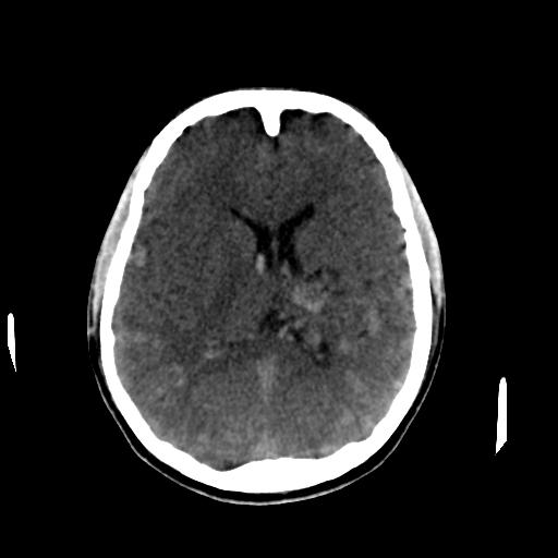 Cerebral arteriovenous malformation (Radiopaedia 28518-28759 Axial non-contrast 40).jpg