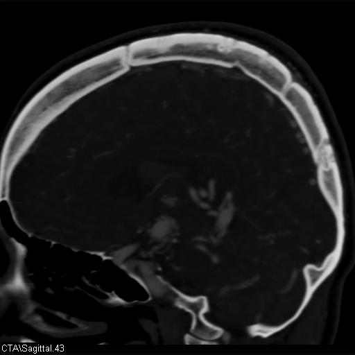 Cerebral arteriovenous malformation (Radiopaedia 28518-28759 D 40).jpg