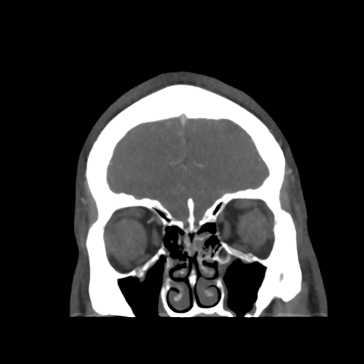 Cerebral arteriovenous malformation (Radiopaedia 39259-41505 E 11).png