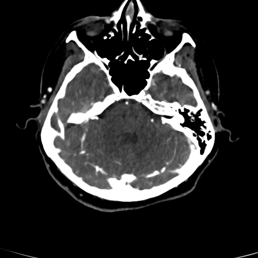 Cerebral arteriovenous malformation (Radiopaedia 73830-84645 Axial C+ delayed 68).jpg